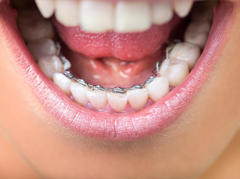 metal braces frankston