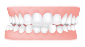 Crossbite of back teeth