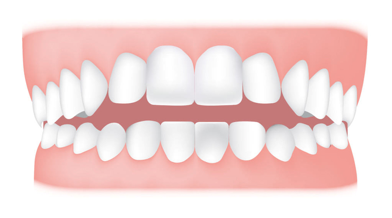 early orthodontics, Introducing Early Orthodontics