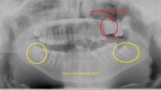 Impacted teeth and Orthodontics