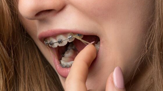 Three things that cause delay in your orthodontic treatment