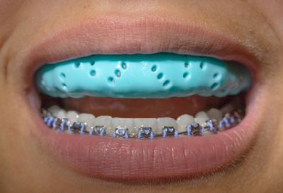 Your Guide to Braces and Mouth Guards