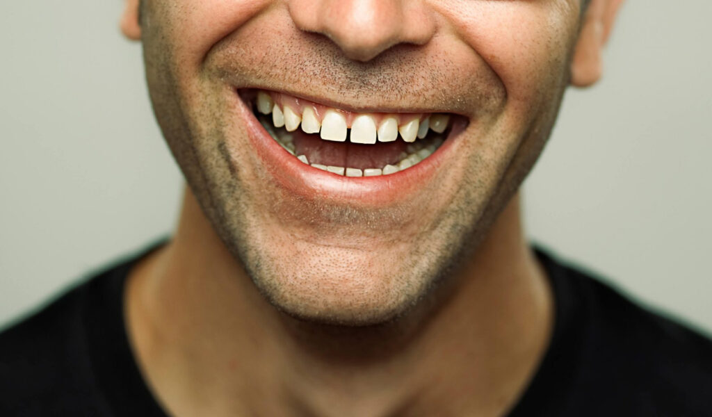 What is a diastema