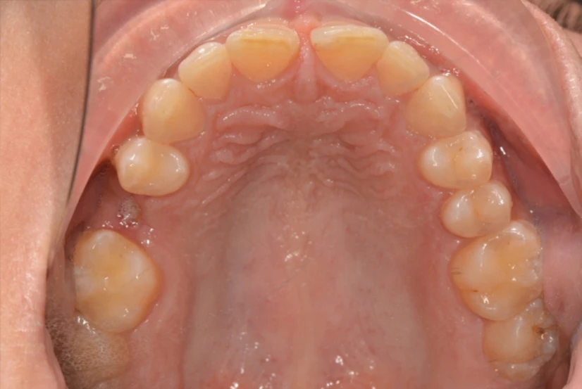 Implant Site Preparation