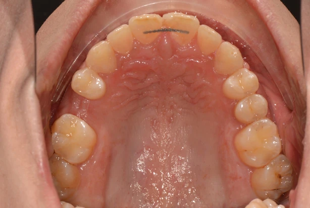 Implant Site Preparation