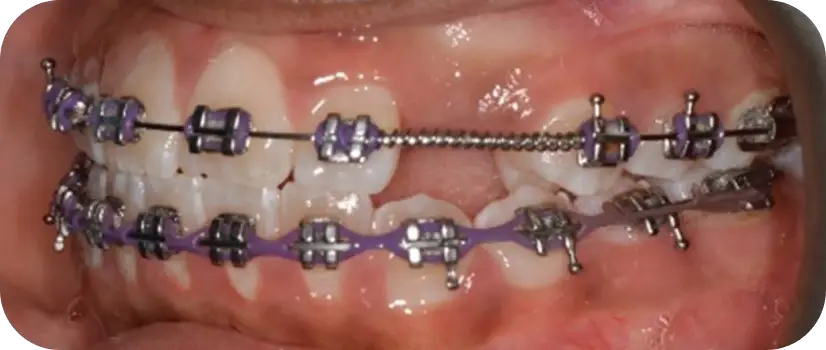 Buccal Canine Exposure