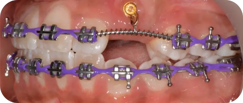 Buccal Canine Exposure