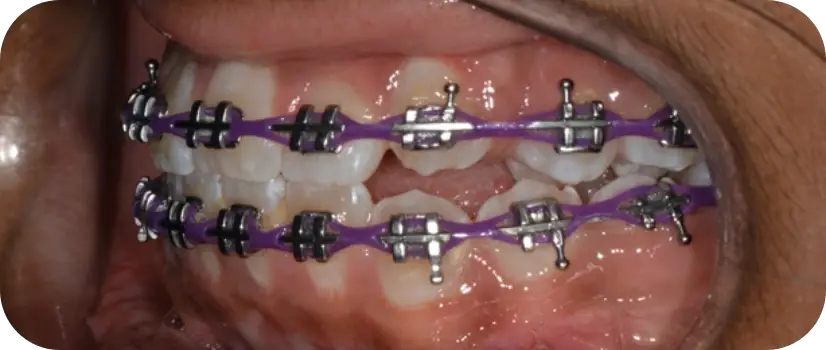 Buccal Canine Exposure