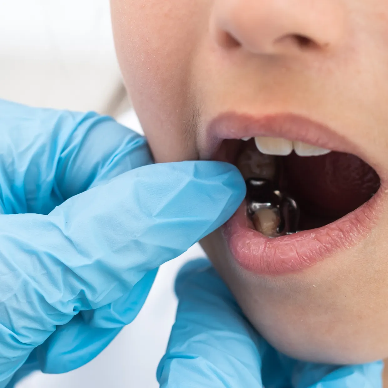 How do plates and expanders work